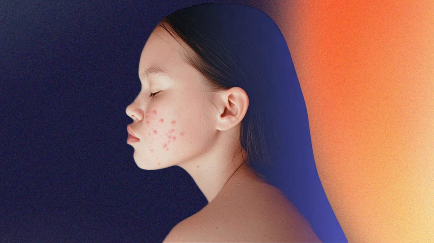 ретиноиды, прыщи, акне, системные ретиноиды, проблемы с кожей,